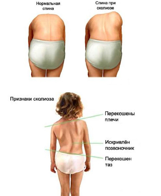 Упражнение при нарушениях осанки
